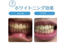 R24 梅田店/ホワイトニング効果