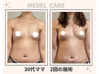 メデル 北千住店/バストアップ*育乳症例