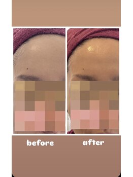 アンジュ(ANGE)/グレーズソフトピーリング症例