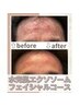 【美肌ケア】水光肌エクソソームフェイシャルコース