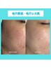 【毛穴撲滅】黒ずみ＆角栓も改善で毛穴レス肌へ★90分¥15,800→¥9,800