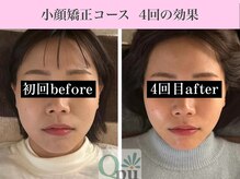 キュープ 表参道店(Qpu)/小顔矯正4回コースの変化