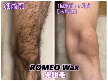 ロミオワックス ジュリエットワックス 新宿店(ROMEO Wax Juliet Wax)/光脱毛経過写真☆メンズ脱毛