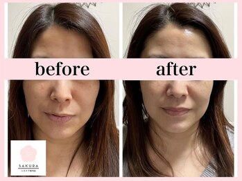 サクラ(SAKURA)/小顔◎お任せください。