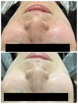 メイユール(MEILLEUR)/光フェイシャル3回