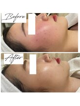 ビズビズ 梅田店(bisebise)/<症例>ぶつぶつ跡・赤み