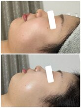 ビジュープラス 幸手店(Bijou+)/美白・シミケア