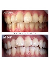 ホワイトニングショップ 上田店/【当店人気No.1】3週間通い放題