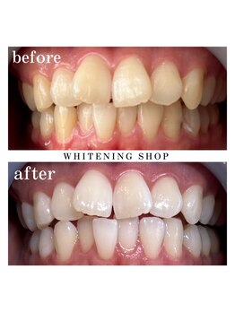 ホワイトニングショップ 上田店/【当店人気No.1】3週間通い放題