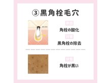 ポアレスラボ 新宿マルイ本館店/黒角栓毛穴