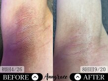 アングレイス(Anngrace)/【全身脱毛脇】Before/After