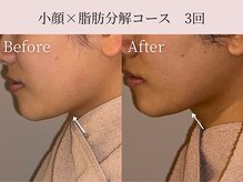 ミア(miiia)/小顔×脂肪分解コース　3回