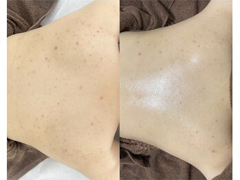 レイ(Lei)/背中ハーブピーリング/本厚木