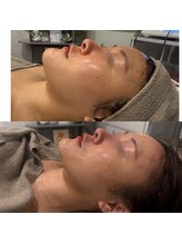 メトルミリ 新宿店(Metre milli)/浮腫、フェイスラインすっきり♪