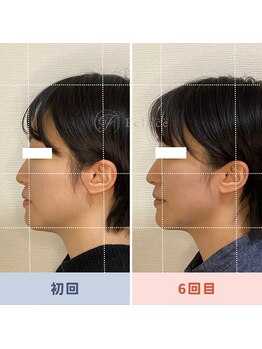 サロン ド フェルーチェ(salon de Feluce)/小顔矯正