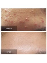 ビビ(VIVI)/ハーブピーリング・ララピール