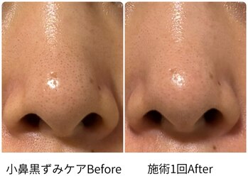 ラ セルフィー(Ra Selfee)/小鼻黒ずみケア