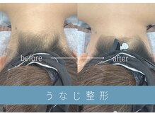 ベル(Belle)/【症例】骨格うなじデザイン