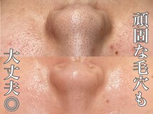 ビジュープラス 広島店(Bijou+)の雰囲気（ハーブピーリング×毛穴洗浄で毛穴トラブルも解決◎）