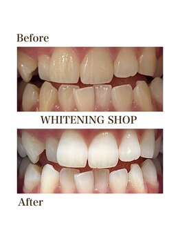 ホワイトニングショップ 守谷店(whitening shop)/ホワイトニングショップ守谷店