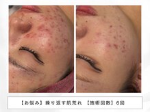 レッド(RED)の雰囲気（プラズマでニキビ・毛穴悩みを解消！ノーファンデ宣言★）