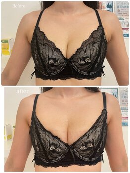 美人バスト 渋谷店/【バストアップ・育乳】症例☆