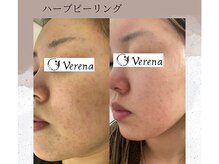 ベルーテ 田町三田(Bellute)/赤みに悩まれてませんか？