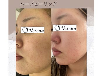 ベルーテ 田町三田(Bellute)/赤みに悩まれてませんか?