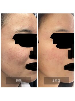 ミドリ(MIDORI)/繰り返すニキビ徹底ケア症例6-1