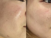 シロ(Shiro)/女性の顔脱毛