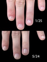 チャームドロップ/深爪、噛み爪補正