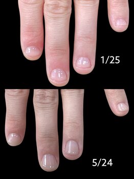 チャームドロップ/深爪、噛み爪補正