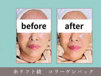 プレジール(plaisir)/糸リフト級のコラーゲンパック