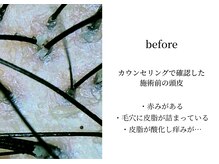 オンビューティーバイコンベックス(On Beauty by convex)/〈ビフォー〉頭皮・毛穴洗浄前