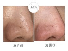 肌音色/■毛穴の角栓汚れ初回施術例。