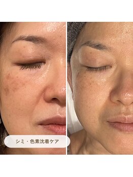 キュレイテッドスキン(CURATED SKIN)の写真/【完全個室】シミケア/毛穴ケアは当店へ☆シミケア当て放題で濃さ/肌状態を見極め丁寧にケアし透明肌に◎