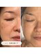 キュレイテッドスキン(CURATED SKIN)の写真/【完全個室】シミケア/毛穴ケアは当店へ☆シミケア当て放題で濃さ/肌状態を見極め丁寧にケアし透明肌に◎
