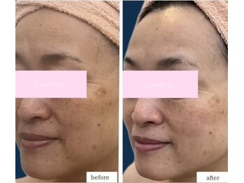 エースマイルイズ(A smile is..)/お客様症例・スキンケア改善