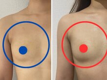 ポインセチア(Poinsettia)/施術回数3回の効果/並び比較