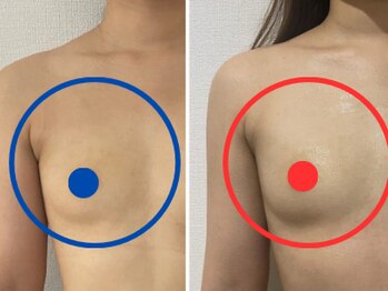 ポインセチア(Poinsettia)/施術回数3回の効果/並び比較