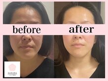 サクラ(SAKURA)/1回で大きな効果◎大満足でした