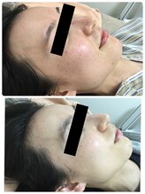 メイユール(MEILLEUR)/光フェイシャル3回