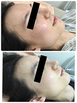 メイユール(MEILLEUR)/光フェイシャル3回