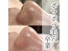 ラエッセ(LAESSE)/ポツポツ毛穴卒業♪