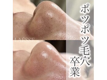 ラエッセ(LAESSE)/ポツポツ毛穴卒業♪