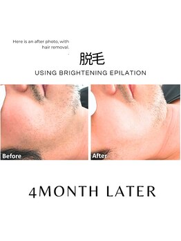 ハグミー 甲子園口(HUGME.)/脱毛のみでツヤ肌まで&若帰り★