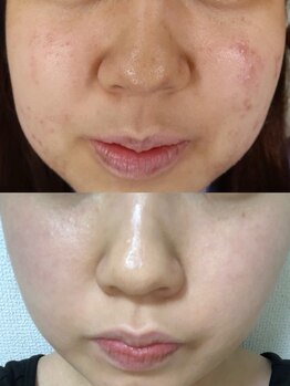 エミュ(emu)/◆トラブル肌・くすみ・ザラつき