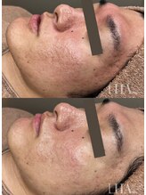 ルルアス(LuLu AS)/