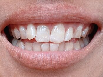 セレウェル 浜松店(SELEWELL)の写真/白い歯で笑顔に自信を♪歯の色でお顔の印象もガラッと変わる！[セルフホワイトニング1回照射¥4000]