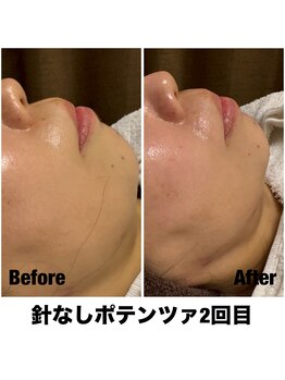 Sスタイルスタジオ 福岡天神/針なしポテンツァ2回目